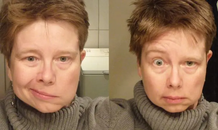 Choque térmico causa paralisia facial? Entenda os sintomas e as causas reais
