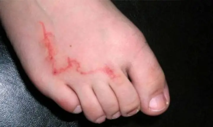 Como evitar bicho-geográfico e outras infecções de pele na areia